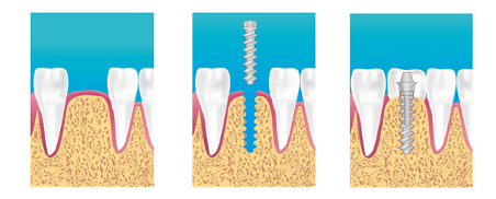 Implants dentaires paris 5